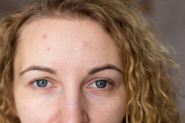 Four lesser-known reasons you get breakouts