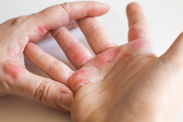 How to treat Eczema & dry, itchy skin