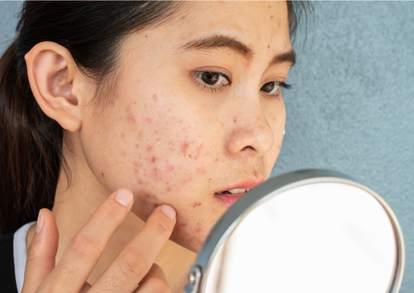 Why do some people get acne?