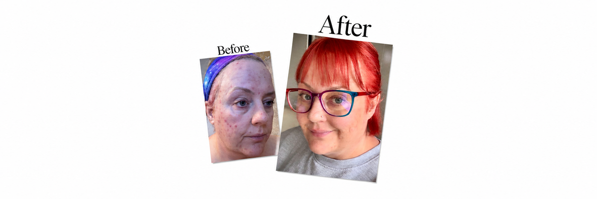 Lisa - Real Skin Stories