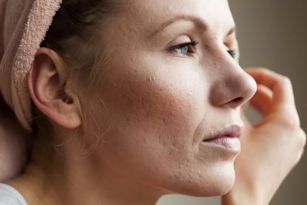Why is no-one talking about Adult Acne?