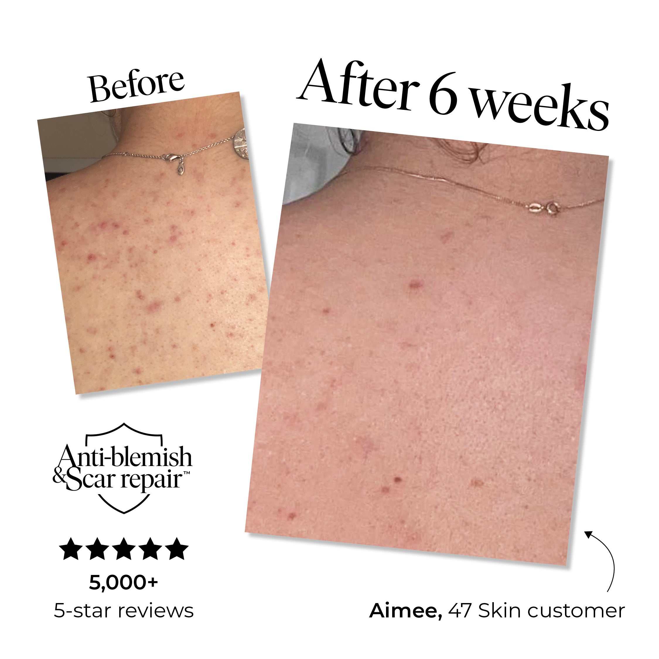 Anti-blemish & Scar Repair Body Moisturizer