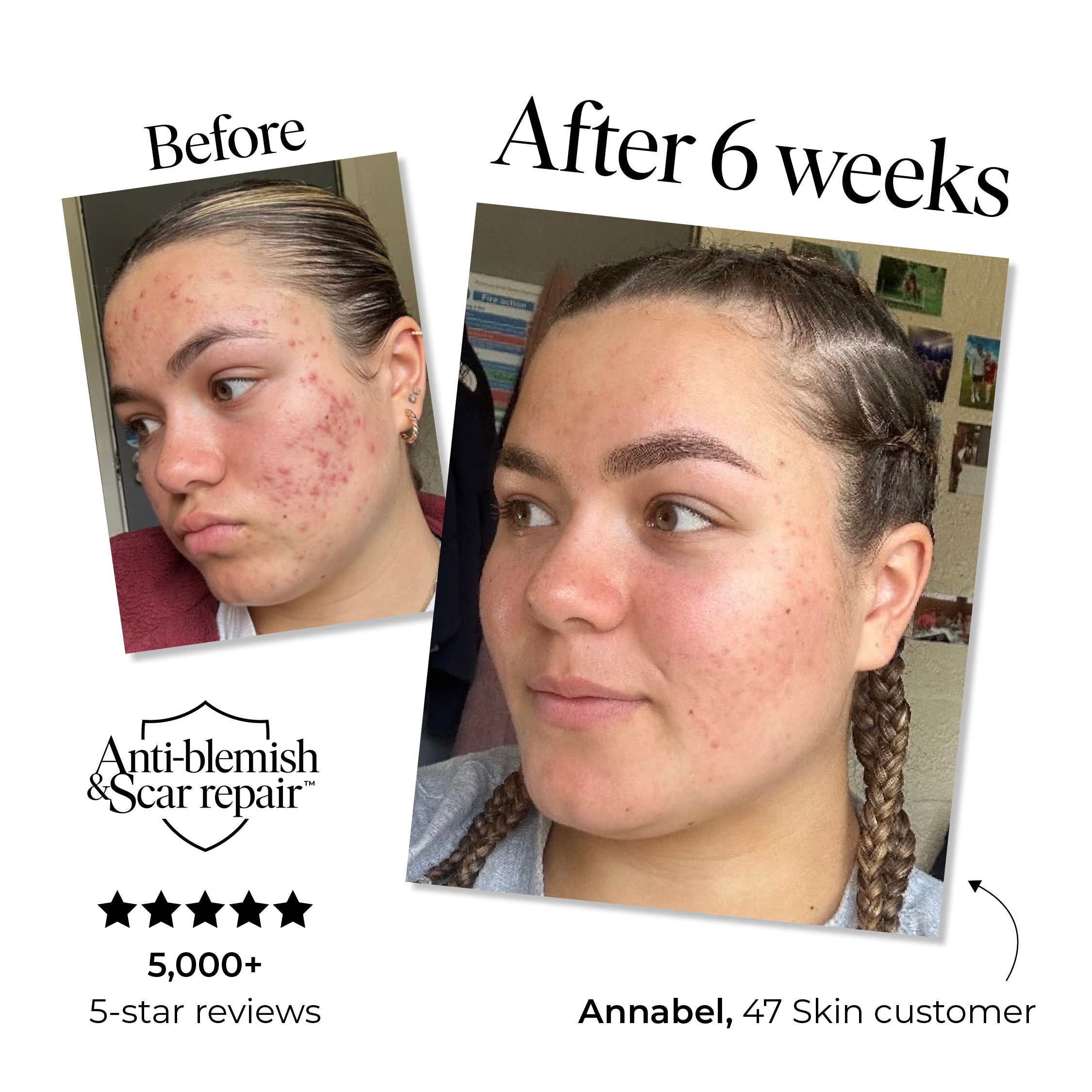 Anti-Blemish & Scar Repair Serum (0.5 fl oz/15ml - 2 Week Trial)