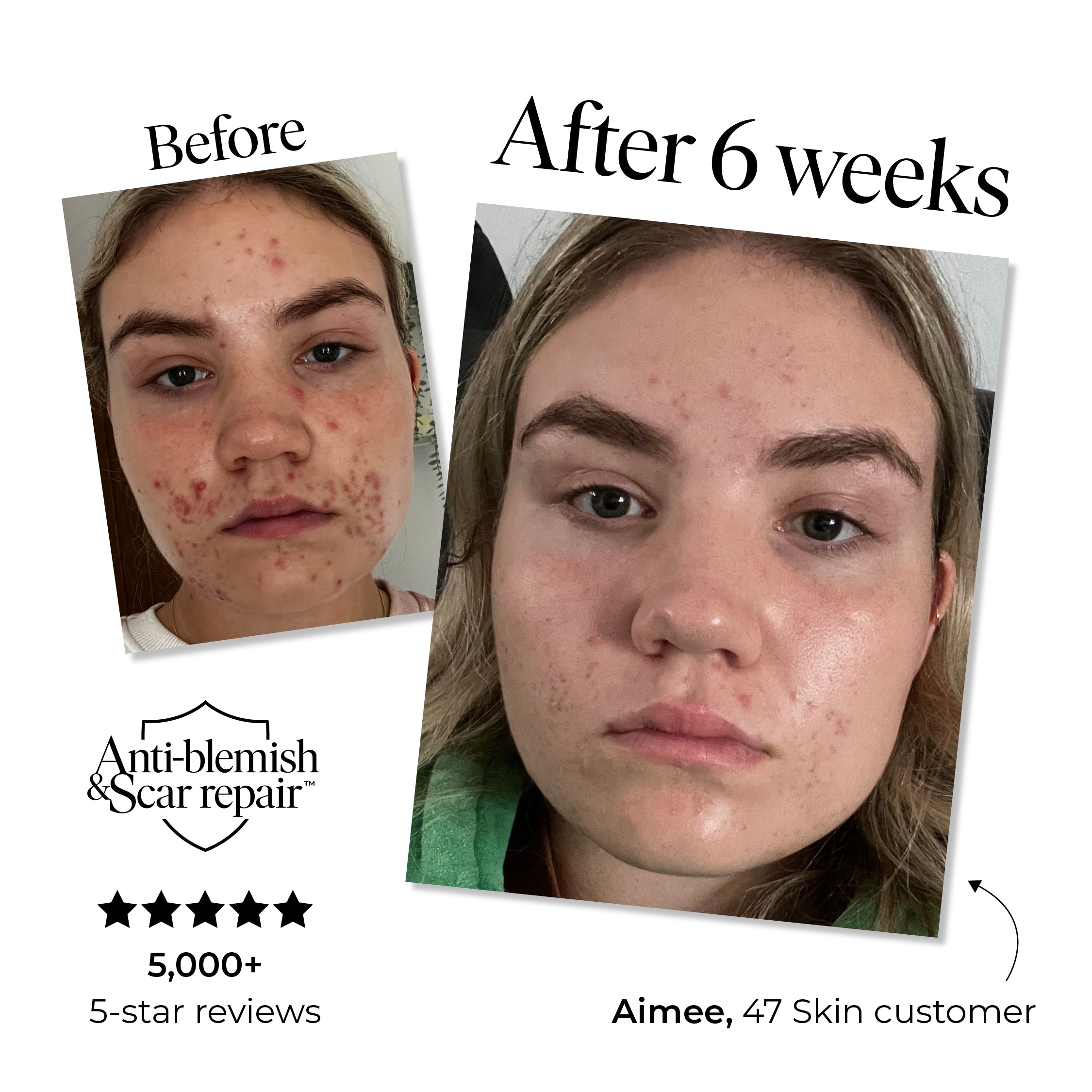 Treatment Serum for persistent, stubborn and cystic blemishes