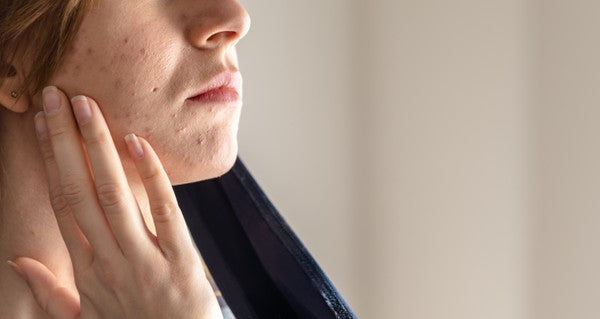 How to Stop Squeezing Your Spots