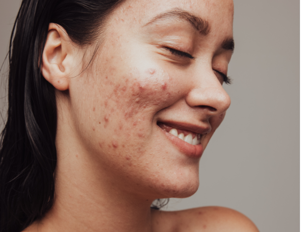 Why going through acne can be a GOOD thing