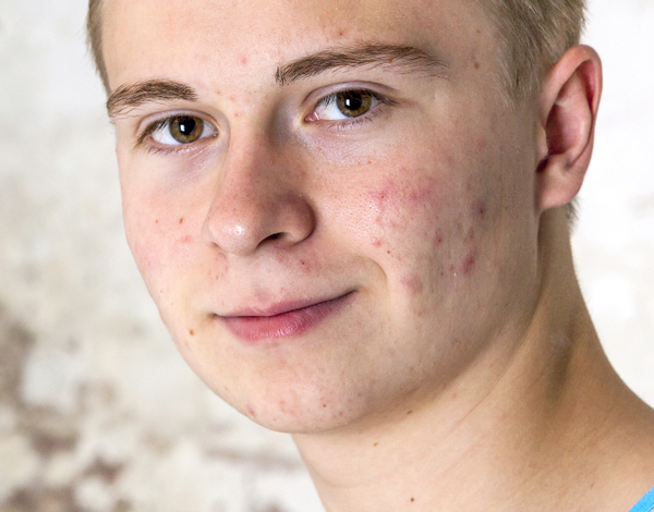 Helping your teen through acne