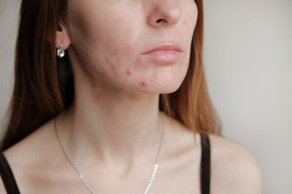 The Truth About Zits