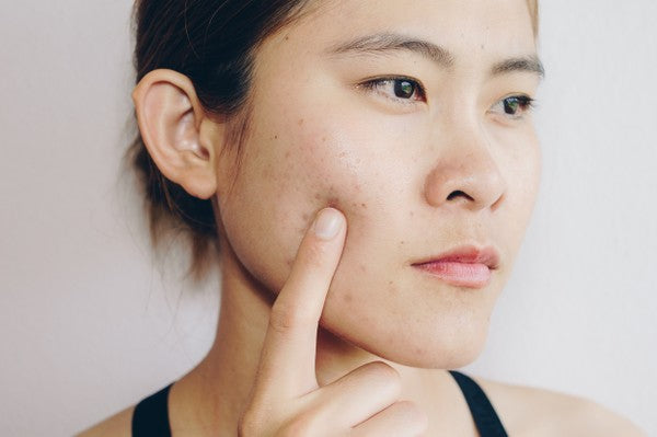 7 Ways to Prevent Acne Scars