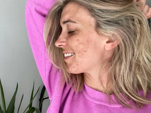 3 top tips for coping with acne