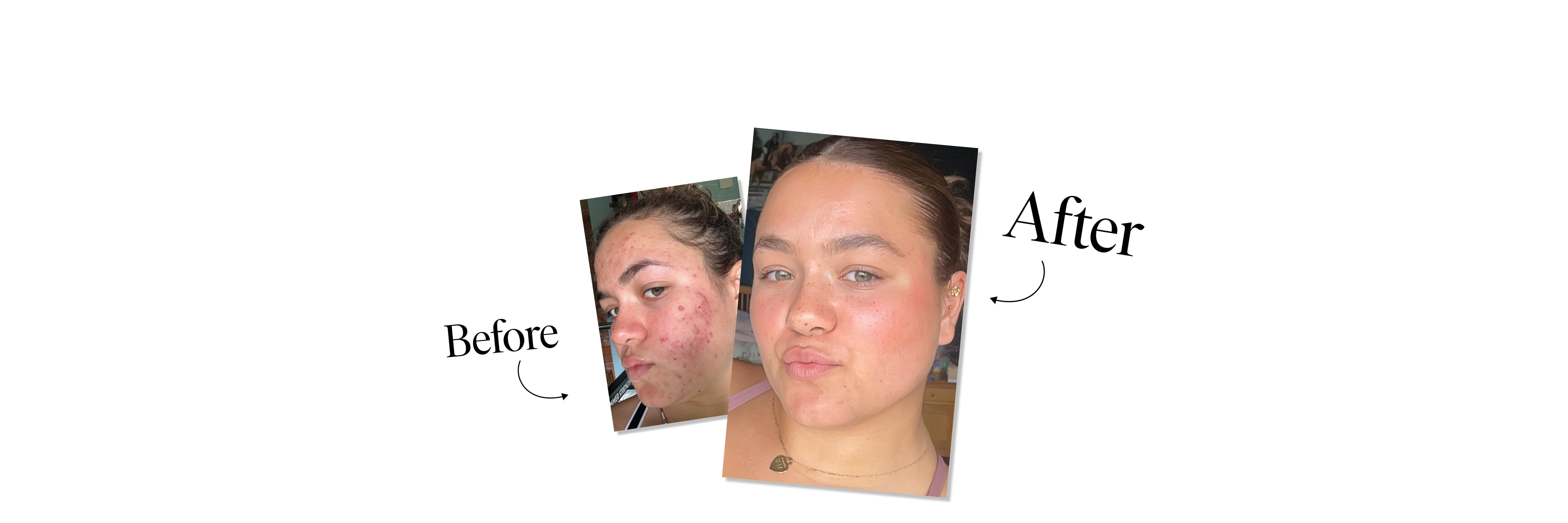 Annabel's Real Skin Story