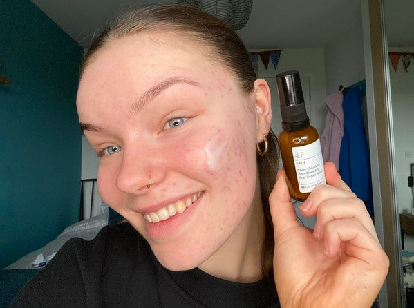 Poppy: How Skin Positivity Changed My Life