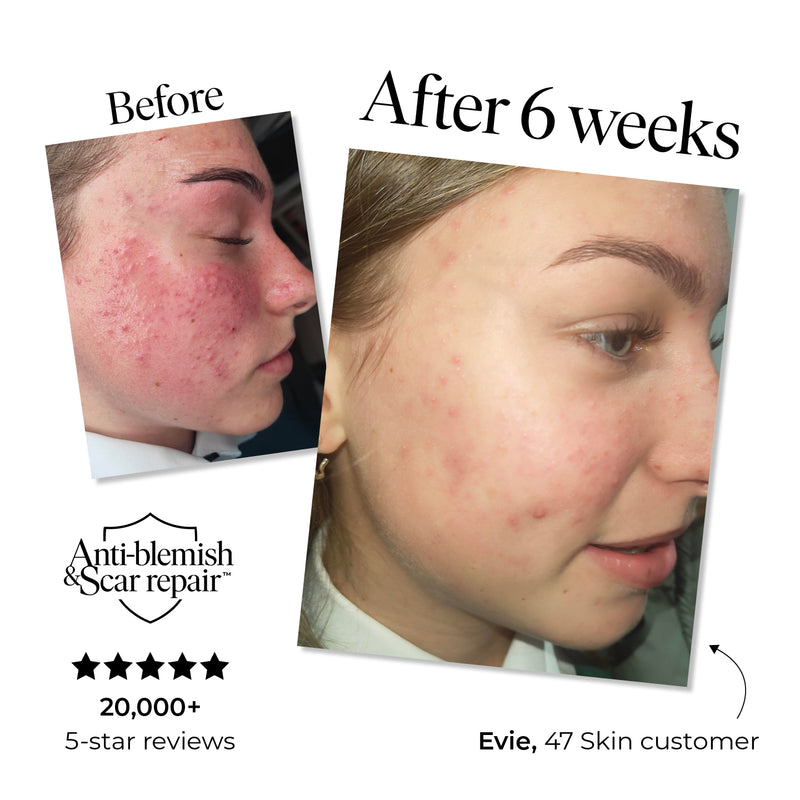 BHA Exfoliant