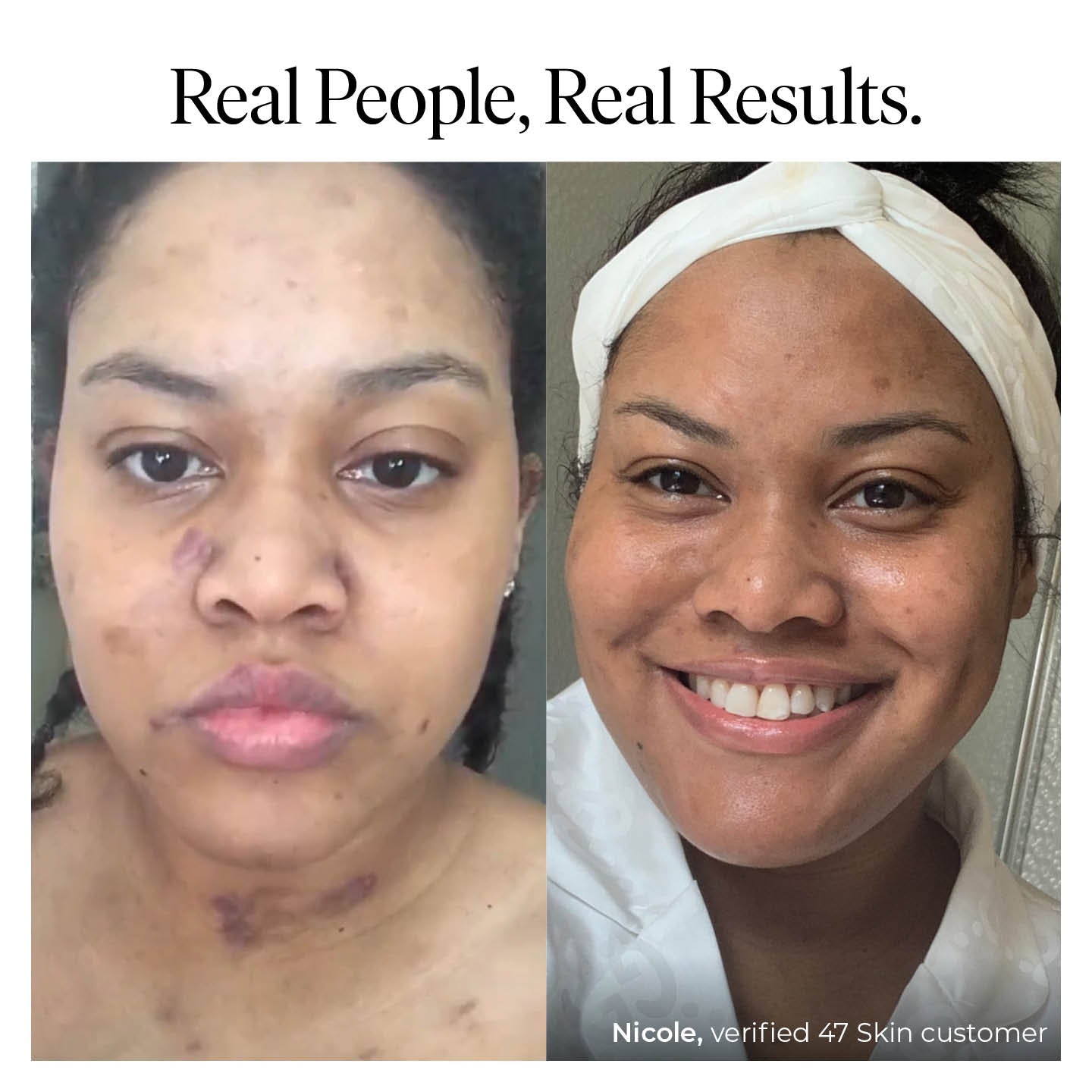 BHA Exfoliant