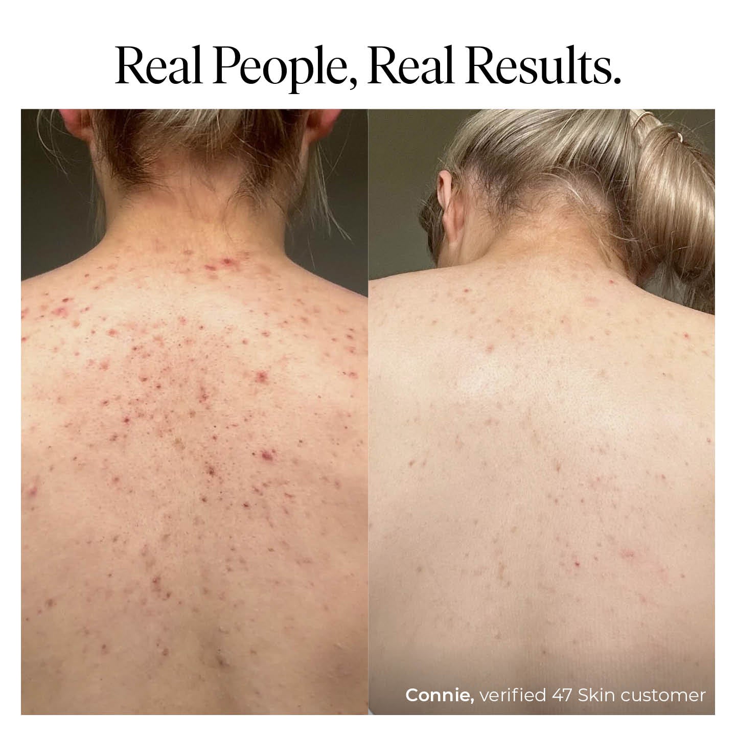 Anti-blemish & Scar Repair Body Moisturizer