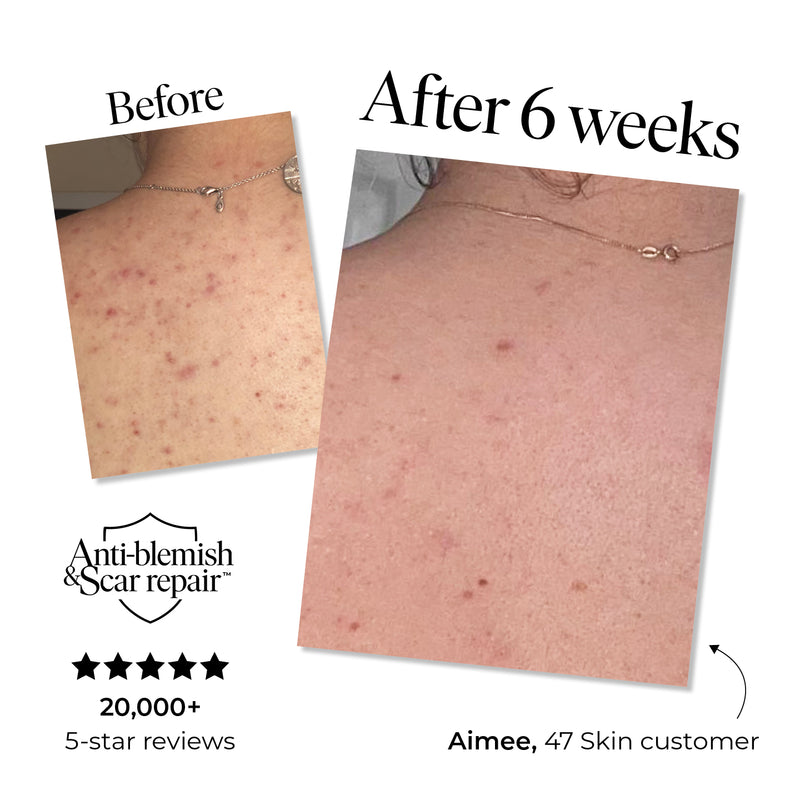 Anti-blemish & Scar Repair Body Moisturizer