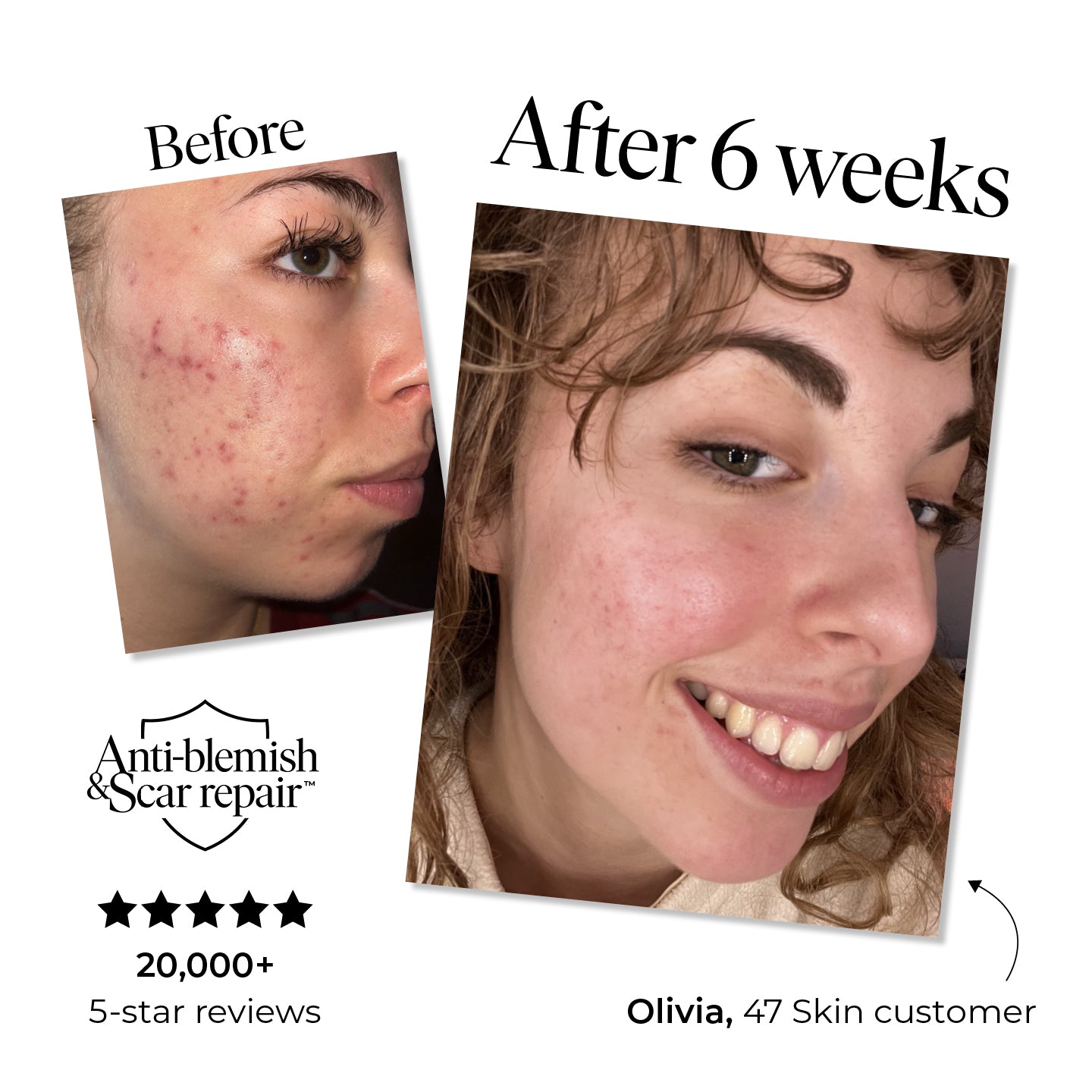 Anti-Blemish & Scar Repair Daily Moisturizer