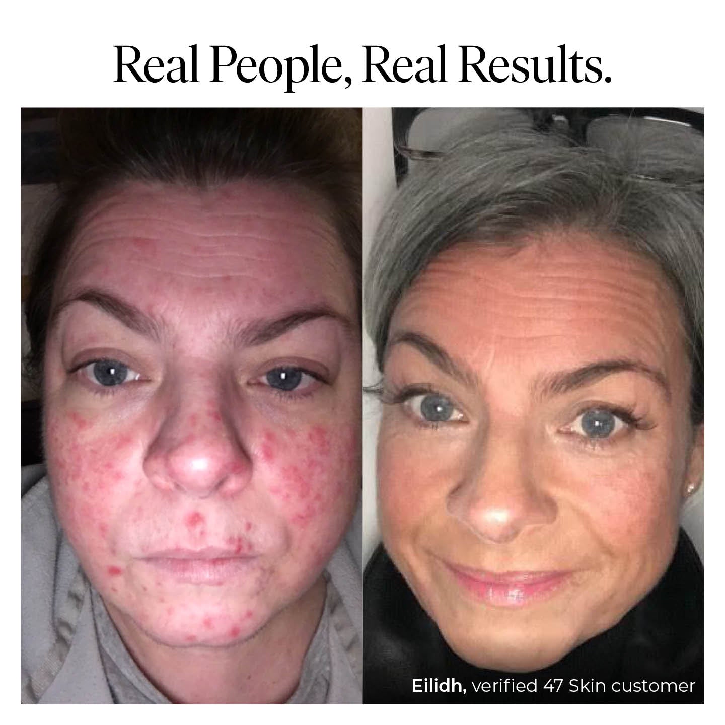 Exfoliating Skin Treatment for persistent, stubborn and cystic blemishes