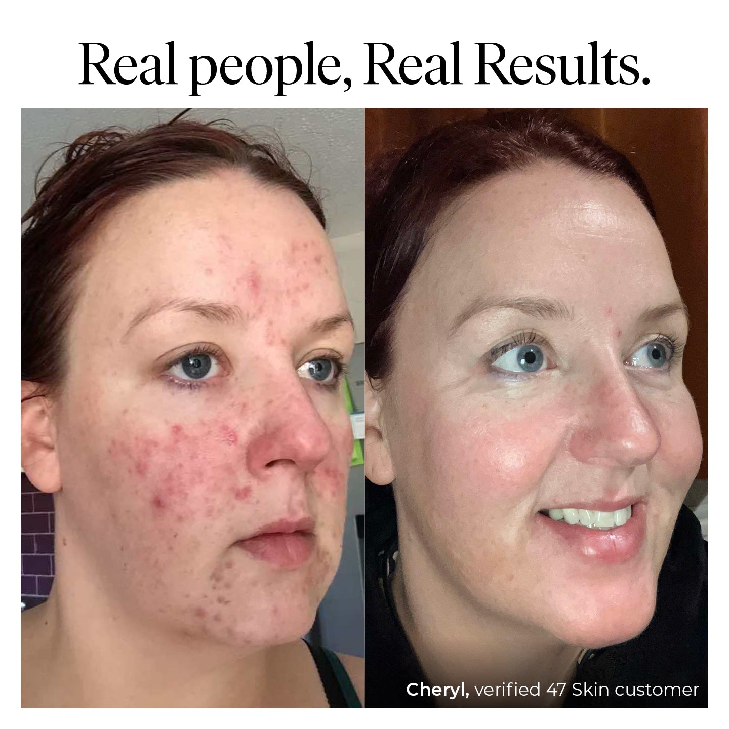 Trial Size Serum : Anti-Blemish & Scar Repair [0.16 fl oz]