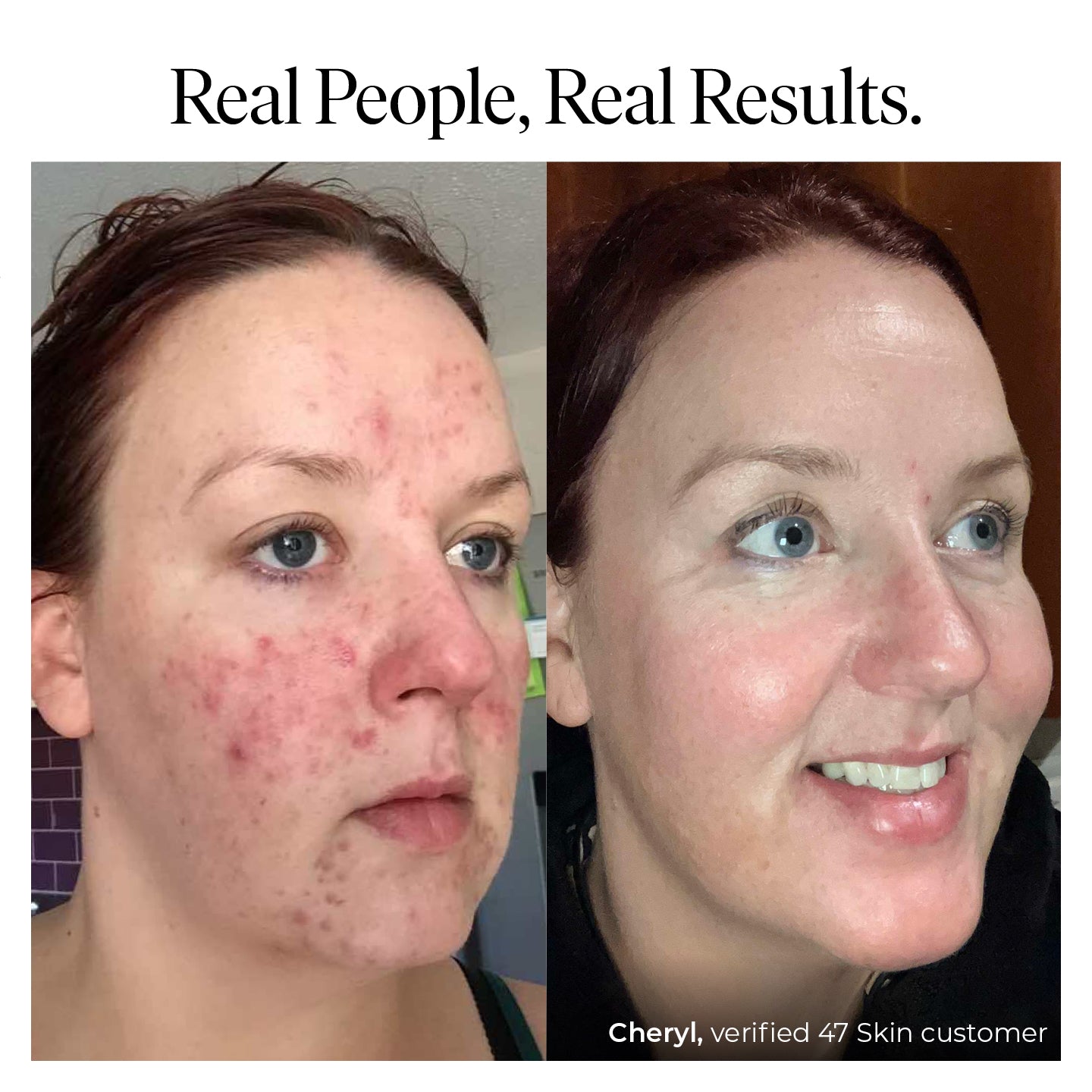 Anti-Blemish & Scar Repair Serum