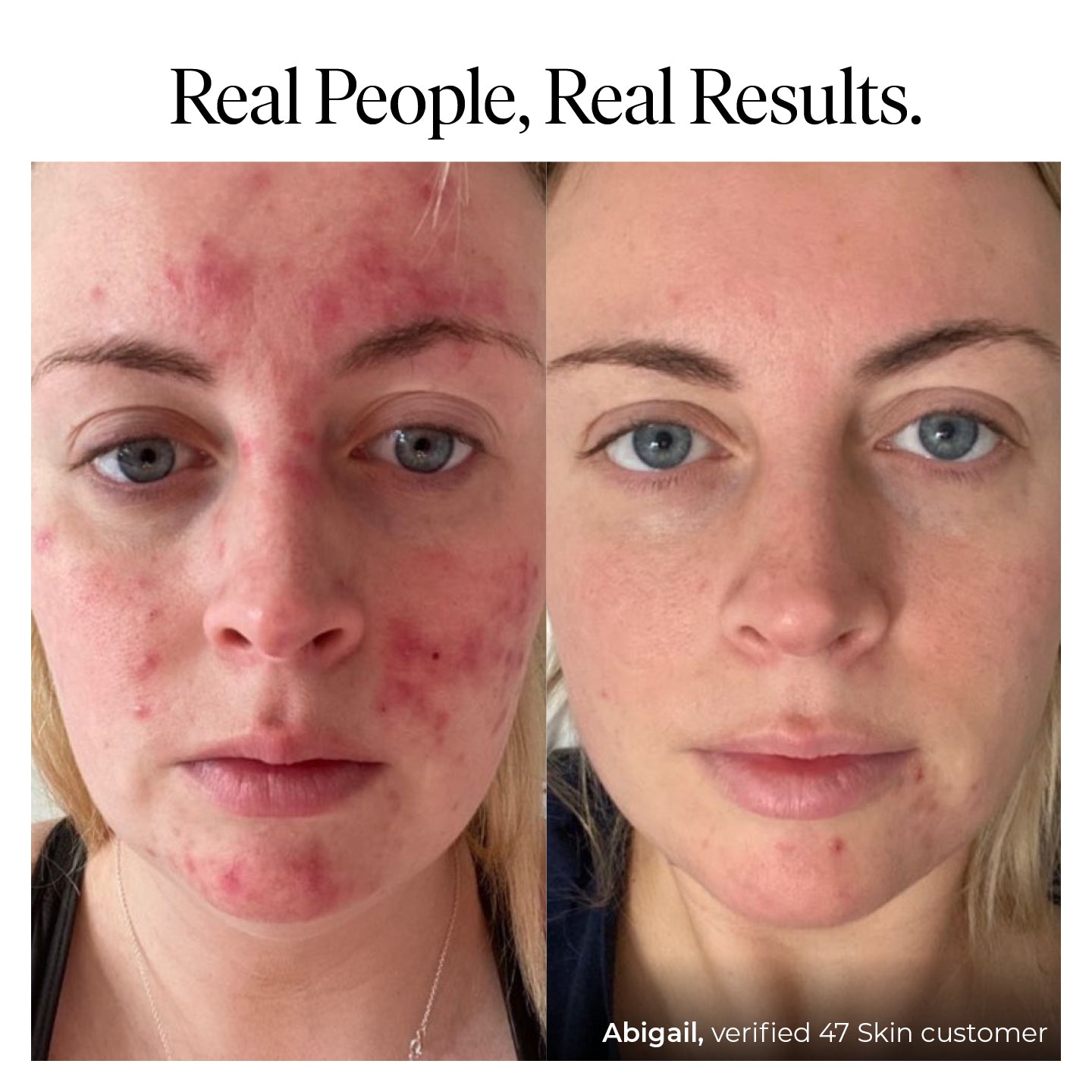 Anti-Blemish & Scar Repair Serum