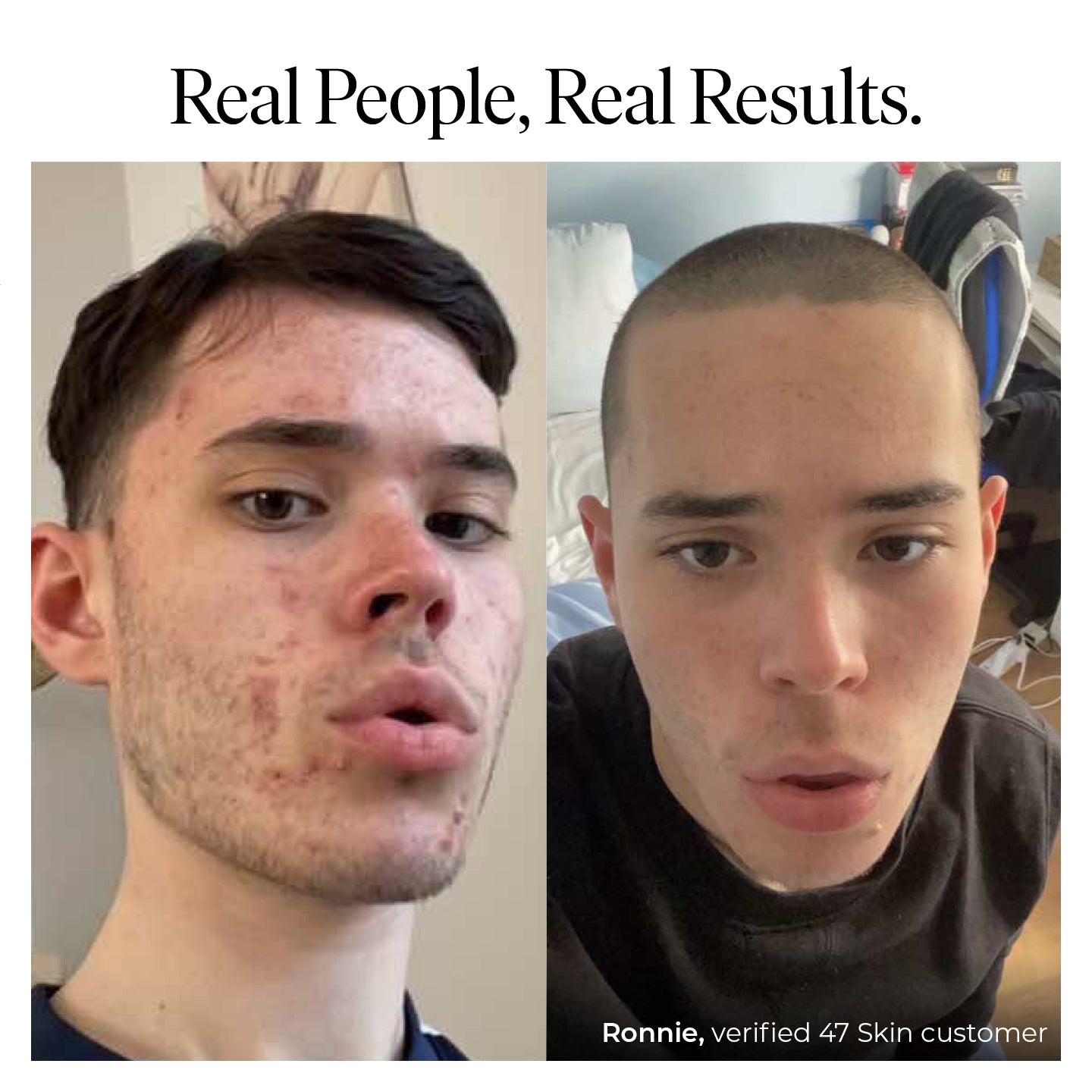 Anti-Blemish and Scar Repair Silver Mask