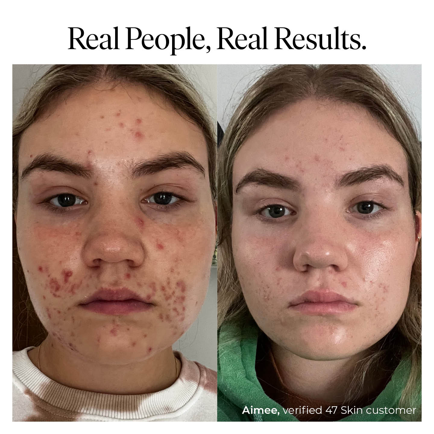 Treatment serum for persistent, stubborn and cystic blemishes
