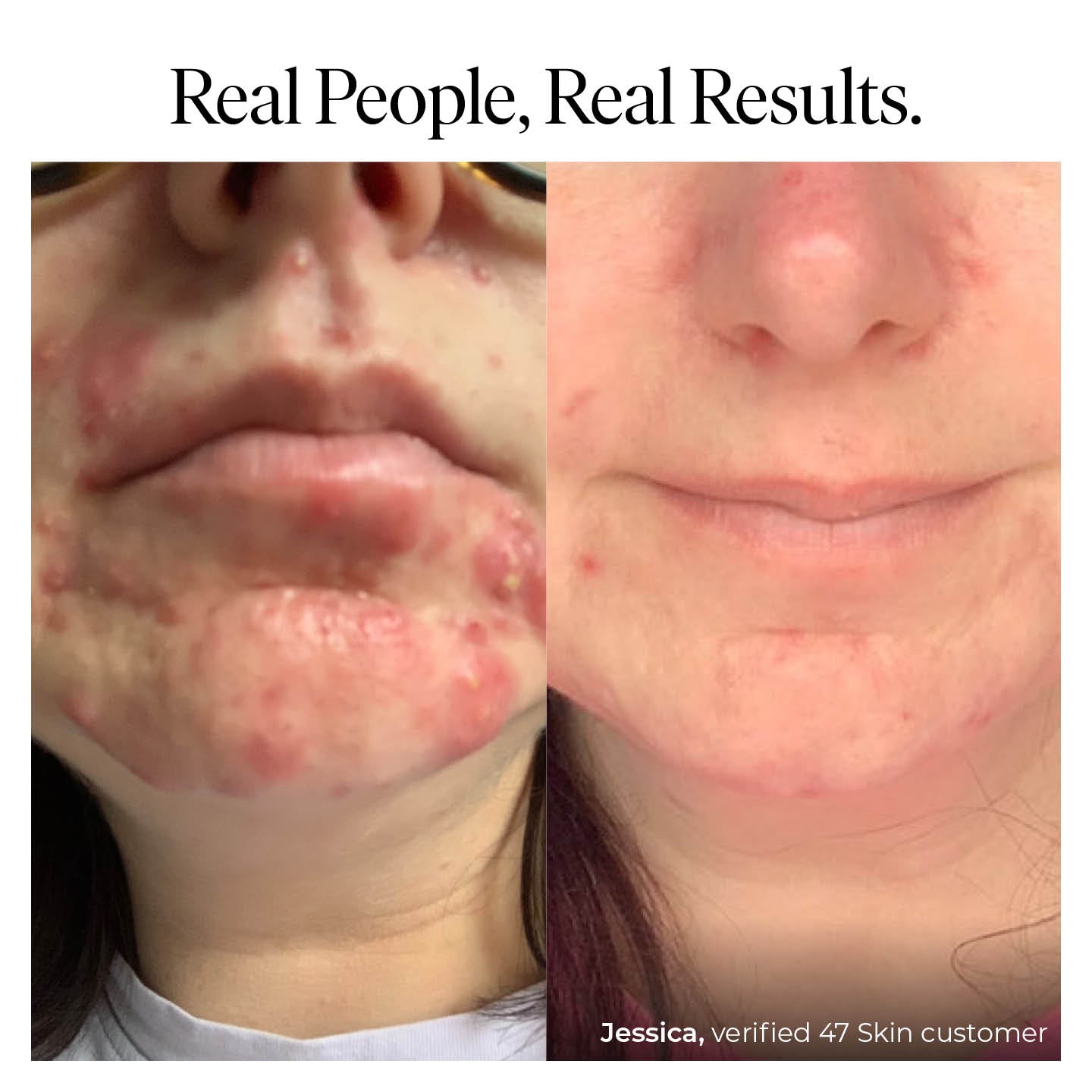Treatment Serum for persistent, stubborn and cystic blemishes