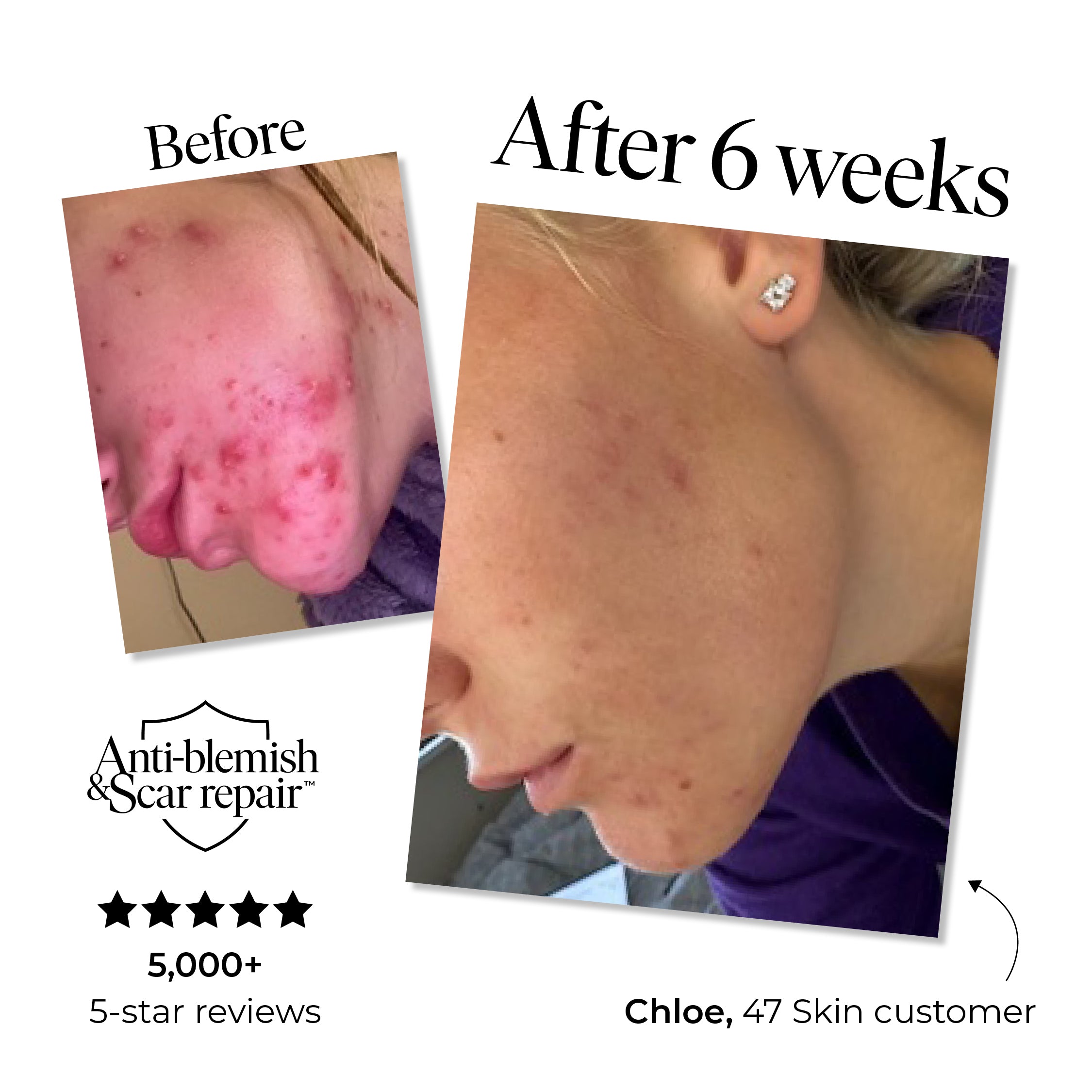 2 Step Treatment Set