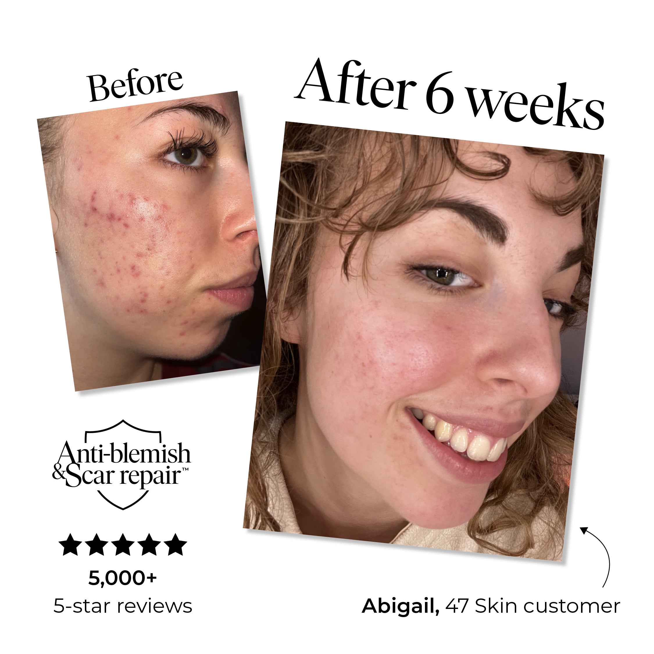 Anti-Blemish & Scar Repair Daily Moisturizer
