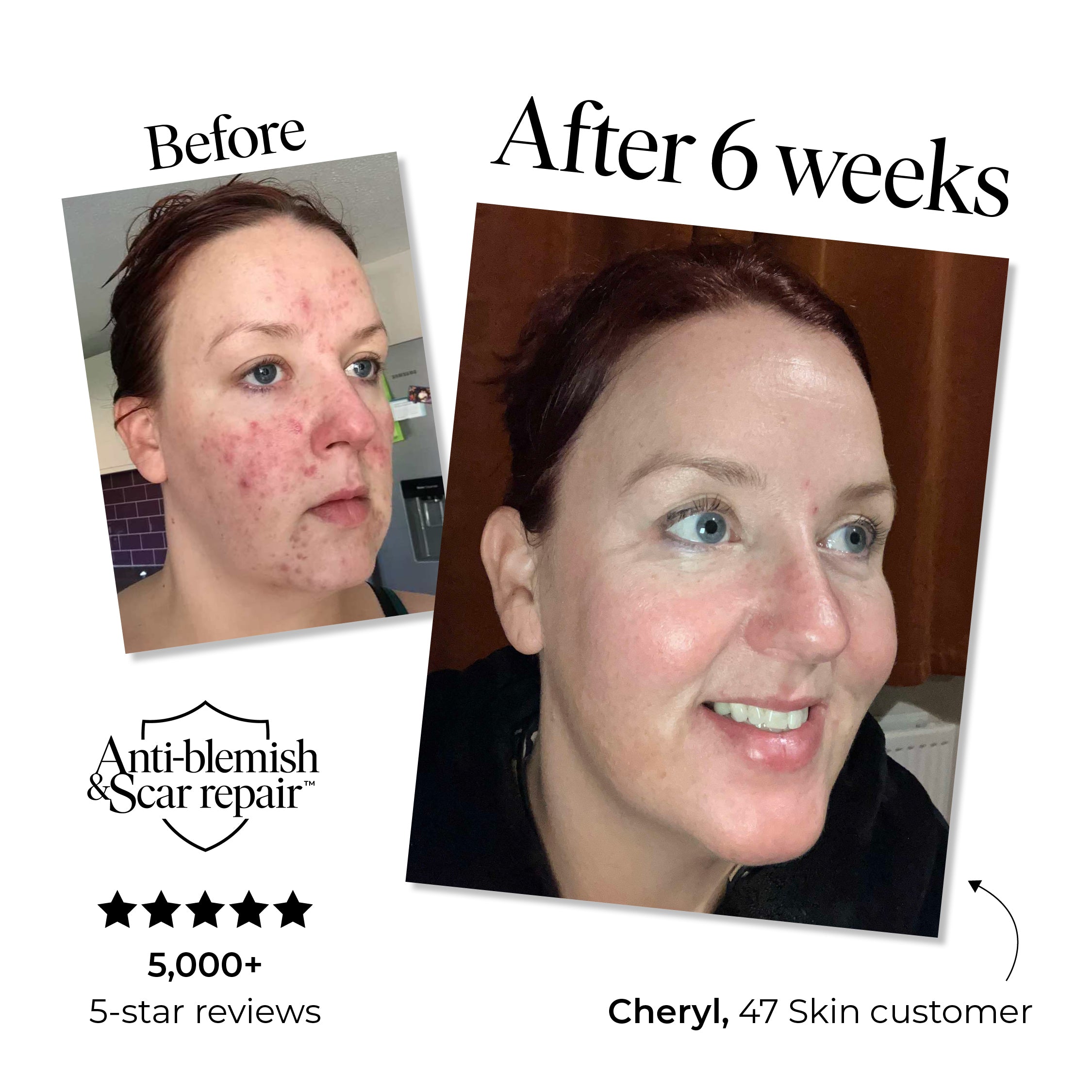 Anti-Blemish and Scar Repair Silver Mask