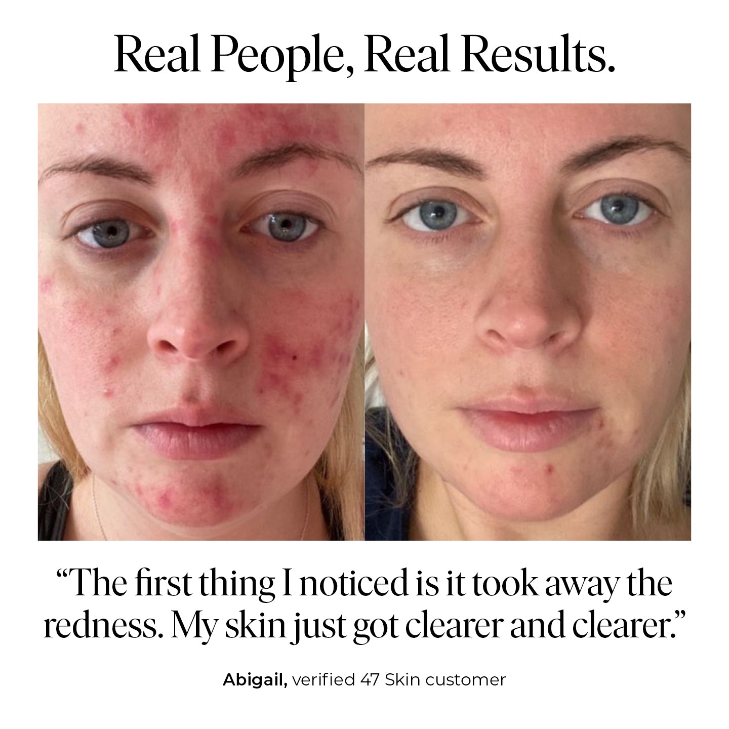 Anti-Breakout & Scar Repair Serum