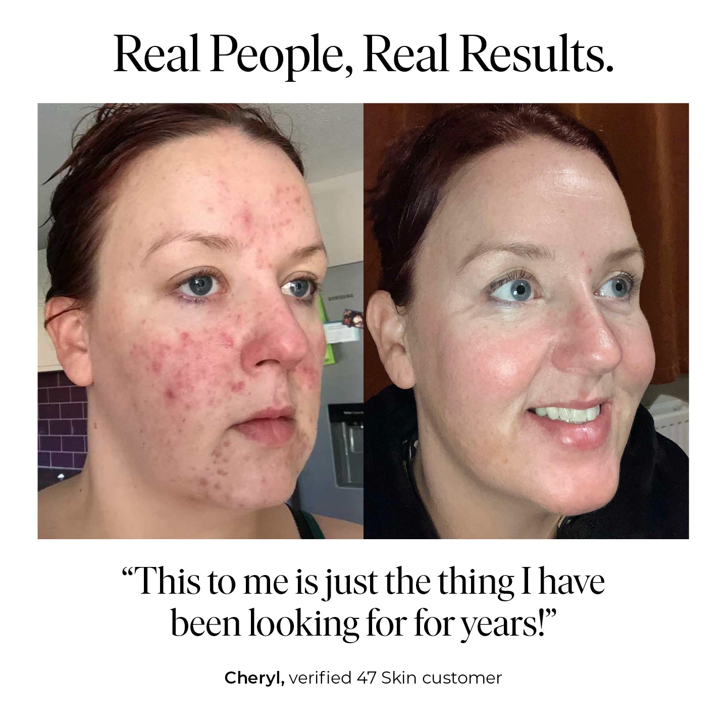 Anti-Breakout & Scar Repair Serum